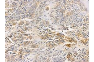 ABIN6259020 and ABIN6276257 at 1/100 staining human lung adenocarcinoma by IHC-P.