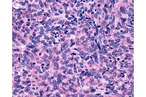 Anti-P2Y10 / P2RY10 antibody IHC of human Lung, Small Cell Carcinoma. (P2RY10 antibody  (Extracellular Domain))