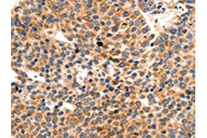 The image on the left is immunohistochemistry of paraffin-embedded Human liver cancer tissue using ABIN7191765(PAFAH1B1 Antibody) at dilution 1/25, on the right is treated with synthetic peptide. (PAFAH1B1 antibody)