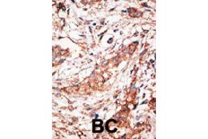 Formalin-fixed and paraffin-embedded human hepatocellular carcinoma tissue reacted with DOK4 polyclonal antibody  , which was peroxidase-conjugated to the secondary antibody, followed by DAB staining. (DOK4 antibody  (C-Term))