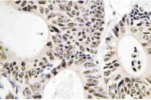 Immunohistochemistry (IHC) analyzes of p53 antibody in paraffin-embedded human colon carcinoma tissue. (p53 antibody)