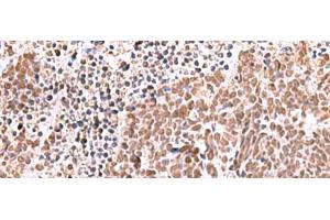 Immunohistochemistry of paraffin-embedded Human lung cancer tissue using RCOR3 Polyclonal Antibody at dilution of 1:60(x200) (RCOR3 antibody)