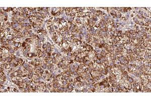 ABIN6279611 at 1/100 staining Human liver cancer tissue by IHC-P.