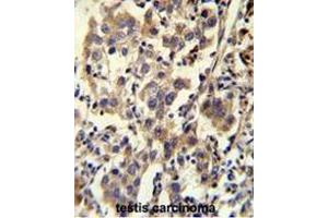 CCDC110 Antibody (C-term) immunohistochemistry analysis in formalin fixed and paraffin embedded human testis carcinoma followed by peroxidase conjugation of the secondary antibody and DAB staining.
