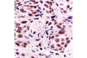 Immunohistochemical analysis of CREB (pS133) staining in human breast cancer formalin fixed paraffin embedded tissue section. (CREB1 antibody  (pSer133))