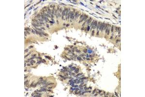 Immunohistochemistry of paraffin-embedded human colon carcinoma using RBBP5 antibody.