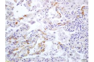 Formalin-fixed and paraffin embedded human lung carcinoma labeled with Anti Integrin alpha V/CD51 Polyclonal Antibody (ABIN678983), Unconjugated at 1:200, followed by conjugation to the secondary antibody and DAB staining