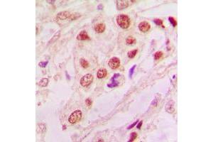 Immunohistochemical analysis of DJ-1 staining in human lung cancer formalin fixed paraffin embedded tissue section. (PARK7/DJ1 antibody  (Center))