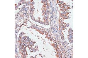 Immunohistochemistry of paraffin-embedded human lung cancer using G antibody  at dilution of 1:100 (40x lens). (GAB1 antibody  (AA 1-150))