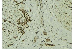 ABIN6273229 at 1/100 staining Human breast cancer tissue by IHC-P. (DOM3Z antibody  (Internal Region))