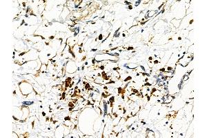 ABIN6263418 and ABIN6276466 at 1/100 staining Human pancreatic cancer by IHC-P.