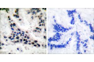 Peptide - +Immunohistochemical analysis of paraffin-embedded human lung carcinoma tissue using HDAC1 antibody (#C0221).