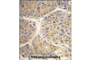 Formalin-fixed and paraffin-embedded human hepatocarcinoma tissue reacted with the SS antibody (Center) (ABIN389270 and ABIN2839403) , which was peroxidase-conjugated to the secondary antibody, followed by DAB staining. (AASS antibody  (AA 264-294))