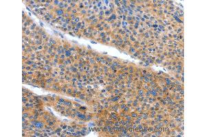 Immunohistochemistry of Human lung cancer using ARL11 Polyclonal Antibody at dilution of 1:50 (ARL11 antibody)
