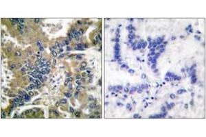 Immunohistochemistry analysis of paraffin-embedded human lung carcinoma tissue, using IL-1 beta (Cleaved-Asp210) Antibody. (IL-1 beta antibody  (Cleaved-Asp210))