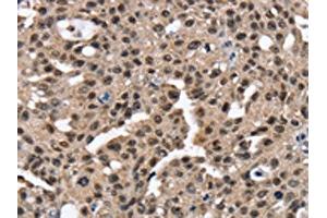 The image on the left is immunohistochemistry of paraffin-embedded Human breast cancer tissue using ABIN7130904(RNF40 Antibody) at dilution 1/25, on the right is treated with fusion protein. (RNF4 antibody)
