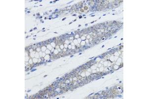 Immunohistochemistry of paraffin-embedded human colon using MonoMethyl-Histone H4-K20 antibody (ABIN3016044, ABIN3016045, ABIN3016046, ABIN1680258 and ABIN6219531) at dilution of 1:200 (40x lens). (Histone H4 antibody  (meLys20))