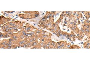 Immunohistochemistry of paraffin-embedded Human liver cancer tissue using ATP5C1 Polyclonal Antibody at dilution of 1:55(x200) (ATP5C1 antibody)