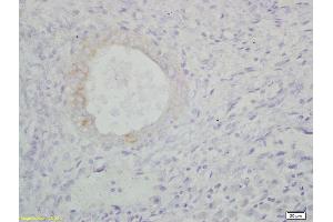 Formalin-fixed and paraffin embedded human endometrium carcinoma labeled with Anti-100-A9/MRP14/CFAG/Calgranulin B Polyclonal Antibody, Unconjugated (ABIN749288) at 1:200, followed by conjugation to the secondary antibody and DAB staining (S100A9 antibody  (AA 51-114))