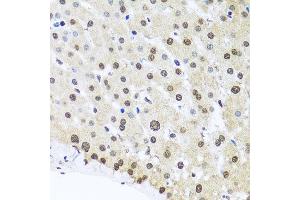 Immunohistochemistry of paraffin-embedded human liver injury using FUBP1 antibody at dilution of 1:100 (x40 lens). (FUBP1 antibody)