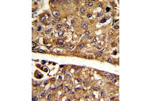 Formalin-fixed and paraffin-embedded human hepatocarcinoma reacted with MDH1 Antibody (C-term), which was peroxidase-conjugated to the secondary antibody, followed by DAB staining.