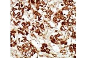 IHC analysis of FFPE human hepatocarcinoma tissue stained with the ZAK antibody (ZAK antibody  (AA 271-300))