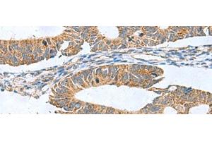 Immunohistochemistry of paraffin-embedded Human colorectal cancer tissue using CLEC1B Polyclonal Antibody at dilution of 1:60(x200) (C-Type Lectin Domain Family 1, Member B (CLEC1B) antibody)