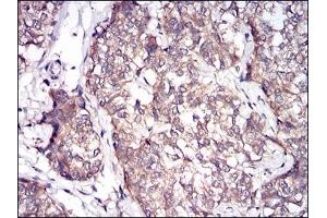 Immunohistochemical analysis of paraffin-embedded human bladder cancer tissues using PRL mouse mAb with DAB staining.