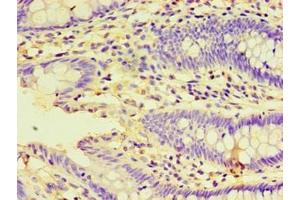 Immunohistochemistry of paraffin-embedded human colon cancer using ABIN7155929 at dilution of 1:100 (HSPBAP1 antibody  (AA 1-488))