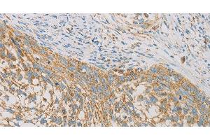 Immunohistochemistry of paraffin-embedded Human cervical cancer tissue using REN Polyclonal Antibody at dilution 1:40 (Renin antibody)