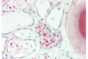 Rabbit Anti-PDE1A antibody Catalog Number: ARP53625 Formalin Fixed Paraffin Embedded Tissue: Human Thyroid Primary antibody Concentration: 1:100 Secondary Antibody: Donkey anti-Rabbit-Cy3 Secondary Antibody Concentration: 1:200 Magnification: 20x Exposure Time: 0. (PDE1A antibody  (C-Term))