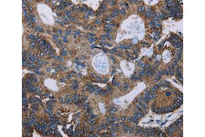 Immunohistochemistry of Human colon cancer using F11R Polyclonal Antibody at dilution of 1:60 (F11R antibody)