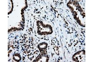Immunohistochemical staining of paraffin-embedded Adenocarcinoma of ovary tissue using anti-LTA4H mouse monoclonal antibody. (LTA4H antibody)