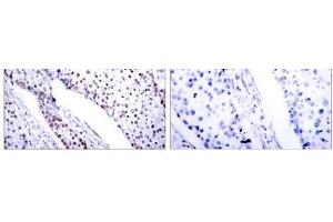 Immunohistochemical analysis of paraffin-embedded human breast carcinoma tissue using STAT3 (Ab-705) antibody (E021045). (STAT3 antibody)