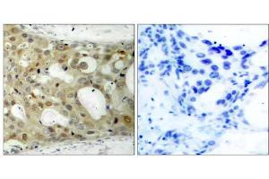 Immunohistochemical analysis of paraffin-embedded human breast carcinoma tissue using Androgen Receptor (Phospho-Ser650) antibody (E011120). (Androgen Receptor antibody  (pSer650))