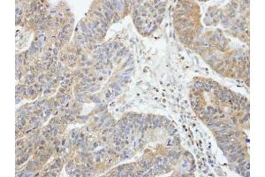 IHC-P Image Immunohistochemical analysis of paraffin-embedded human gastric cancer, using RIP2, antibody at 1:100 dilution. (RIPK2 antibody)