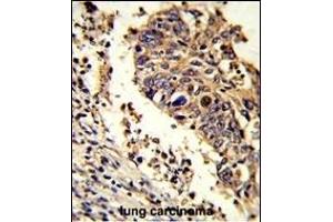 Formalin-fixed and paraffin-embedded human lung carcinoma reacted with LUC7L Antibody (C-term), which was peroxidase-conjugated to the secondary antibody, followed by DAB staining. (LUC7L antibody  (C-Term))