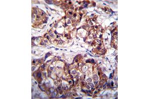DDR1 Antibody immunohistochemistry analysis in formalin fixed and paraffin embedded human breast carcinoma followed by peroxidase conjugation of the secondary antibody and DAB staining. (DDR1 antibody  (AA 299-330))