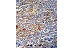 C9orf156 Antibody immunohistochemistry analysis in formalin fixed and paraffin embedded human skin carcinoma followed by peroxidase conjugation of the secondary antibody and DAB staining. (C9orf156 antibody  (C-Term))
