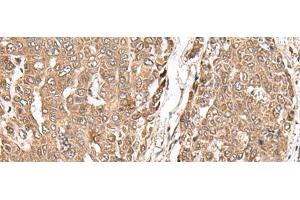 Immunohistochemistry of paraffin-embedded Human liver cancer tissue using MAGOHB Polyclonal Antibody at dilution of 1:70(x200) (Mago Nashi Homolog 2 antibody)