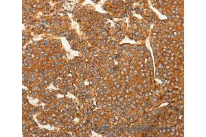Immunohistochemistry of Human lung cancer using SFRP1 Polyclonal Antibody at dilution of 1:80 (SFRP1 antibody)