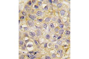 Formalin-fixed and paraffin-embedded human breast carcinoma tissue reacted with EphB2 antibody (C-term), which was peroxidase-conjugated to the secondary antibody, followed by DAB staining. (EPH Receptor B2 antibody  (C-Term))