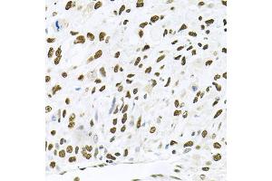 Immunohistochemistry of paraffin-embedded human lung cancer using MAPK8 antibody (ABIN5970116) at dilution of 1/100 (40x lens). (JNK antibody)