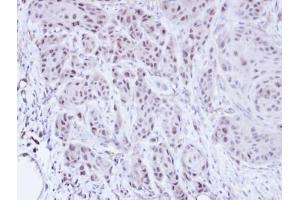 IHC-P Image Immunohistochemical analysis of paraffin-embedded Cal27 xenograft, using SCMH1, antibody at 1:100 dilution. (SCMH1 antibody  (Center))
