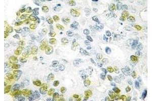 Immunohistochemistry analyzes of C/EBP-α antibody in paraffin-embedded human colon carcinoma tissue. (CEBPA antibody)