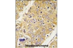Formalin-fixed and paraffin-embedded human hepatocarcinoma tissue reacted with Dtnbp1 Antibody (C-term) (ABIN389170 and ABIN2839336) , which was peroxidase-conjugated to the secondary antibody, followed by DAB staining. (DTNBP1 antibody  (C-Term))