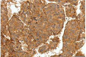 Immunohistochemistry of Human breast cancer using COL4A1 Polyclonal Antibody at dilution of 1:30 (COL4A1 antibody)