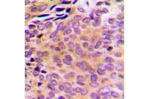 Immunohistochemical analysis of AKR1CL2 staining in human breast cancer formalin fixed paraffin embedded tissue section. (AKR1E2 antibody  (Center))