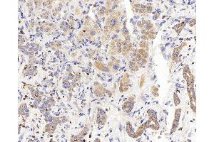 Immunohistochemistry analysis of paraffin-embedded human liver cancer using PERK Polyclonal Antibody at dilution of 1:400. (PERK antibody)