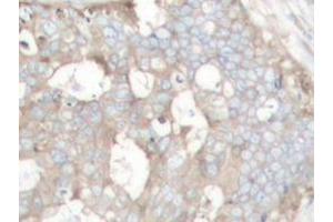 Immunohistochemistry analyzes of Cortactin antibody in paraffin-embedded human prostate carcinoma tissue. (Cortactin antibody)